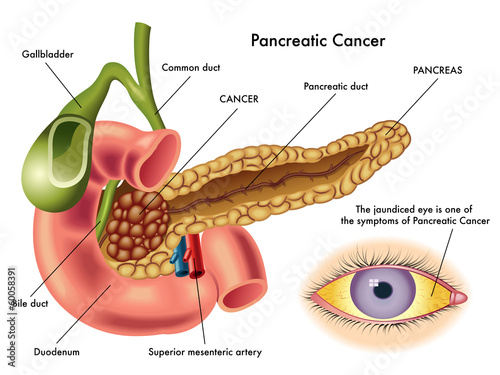 cncer pancreas