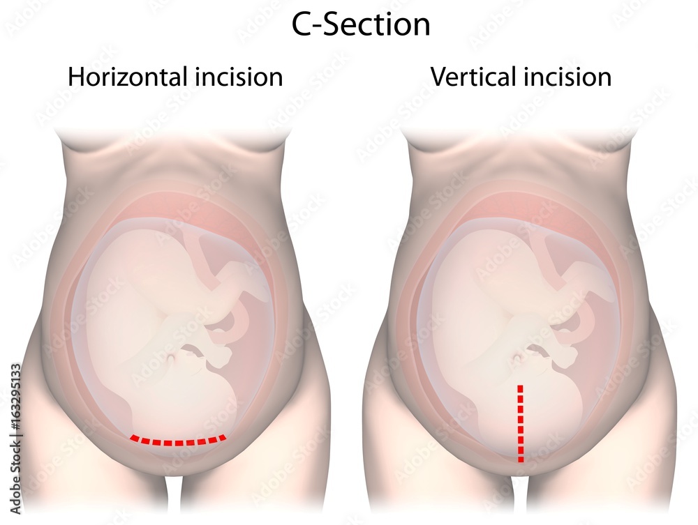 Safe to orgasm after cesarean section