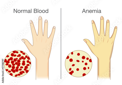 anemie ciroza hepatică