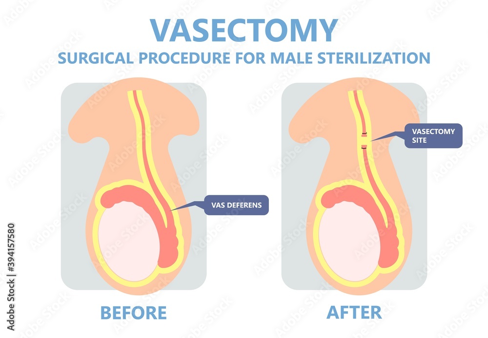 Vasectomy Male Sterilisation Ejaculate Contraceptive Genitalia