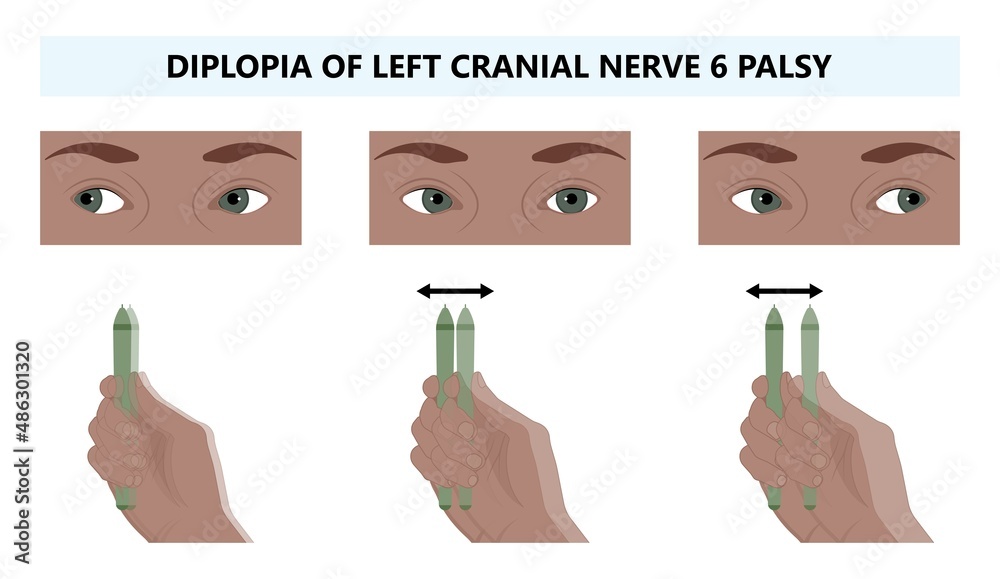 Diplopia Double Vision Test Exam Brain Nerve Dry Eye Palsy Gravis