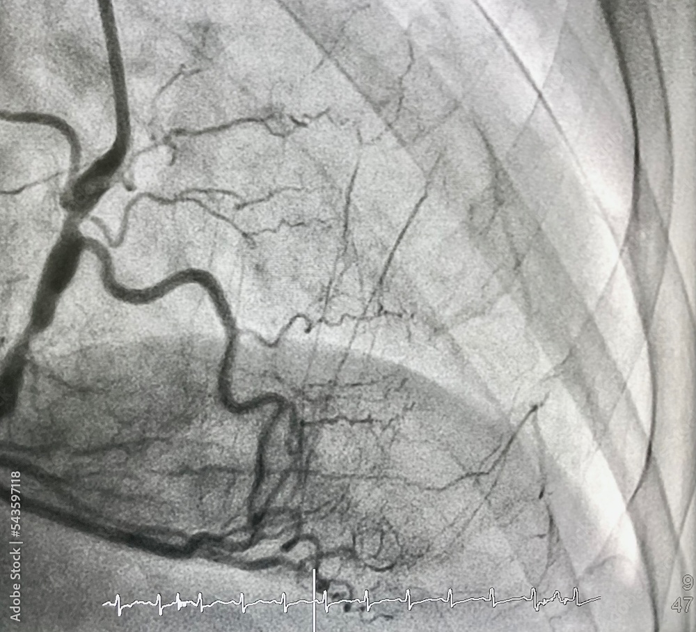 Coronary Angiogram Cag Shown Right Coronary Artery Stenosis And Given