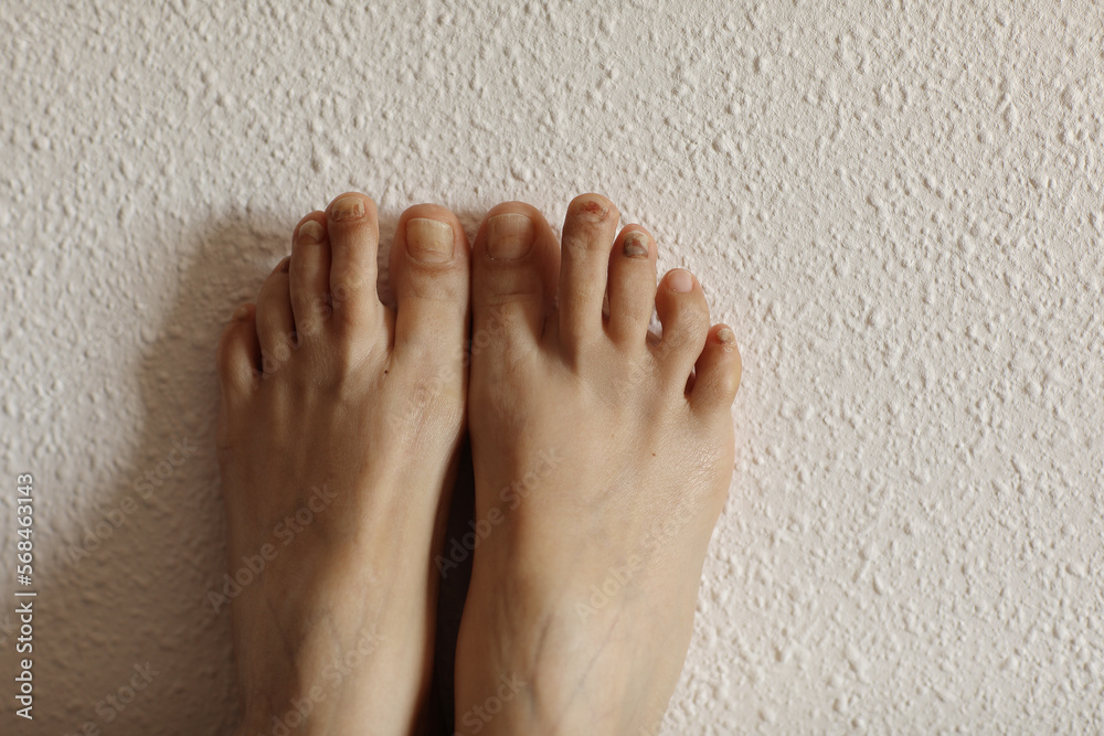 Foto De Female Feet With Subungual Hematoma Black Toenails Caused By