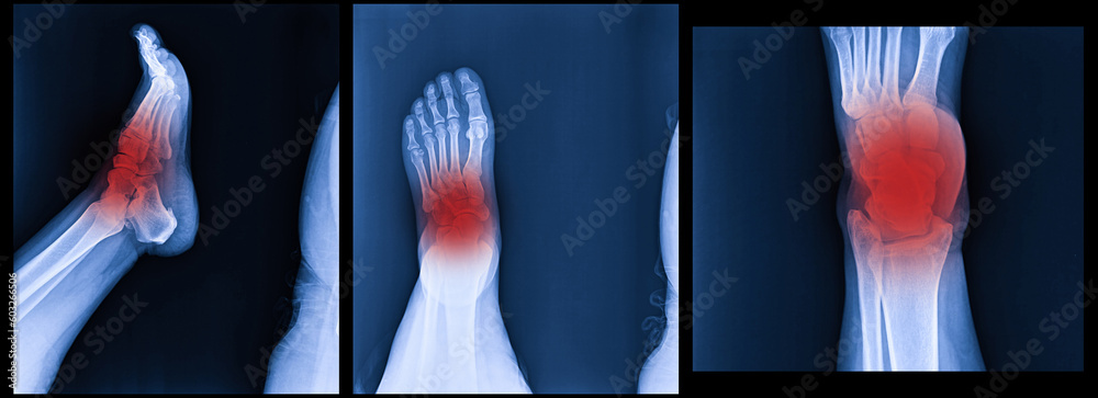 Foot And Ankle Pain On X Ray Isolated On Black Background Stock Photo