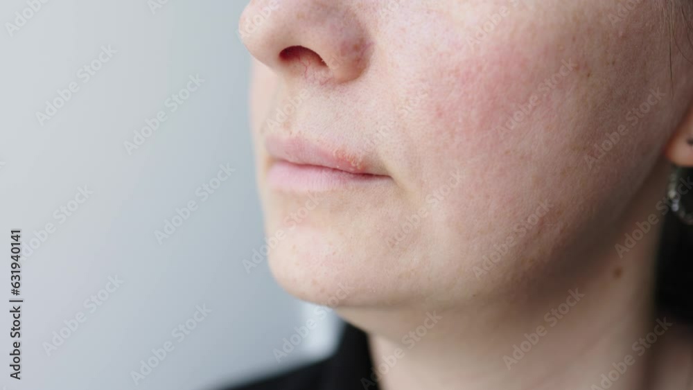 Virus Herpes Simplex On Lip Skin Sore Vesicles Cause Discomfort Of