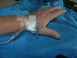 intravenous IV feed in hospital patient's arm