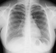 Radiographie thorax de face