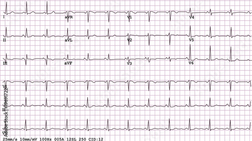 Example Of A Normal 12 Lead Sinus Rhythm Ecg Stock Vector Adobe Stock