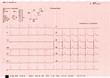 The graphs of an electrocardiogram