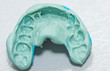Dental imprint - impression taken with silicone material