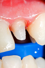 Tooth Stub For Dental Crown