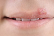 © uwimages - Close up of lips affected by herpes.