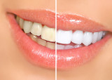 Fototapeta Konie - teeth whitening