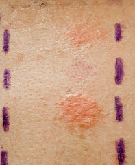 skin allergy patch test on back of patient