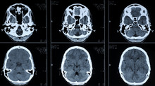 CT Photography Of Human Brain