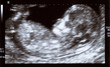 Ecografía de un feto - Primer plano realizado con el ecógrafo