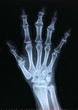 X-ray / Hand