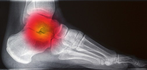 painful human right foot ankel xray picture (external side)