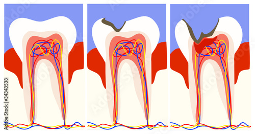 Karies Stadien Buy This Stock Vector And Explore Similar Vectors At Adobe Stock Adobe Stock
