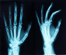 X-ray Of A Hand