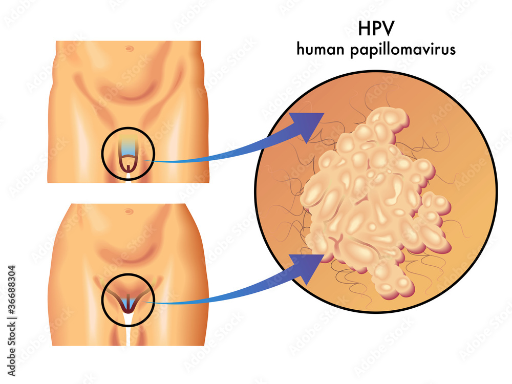 hpv papilomavirus uman)
