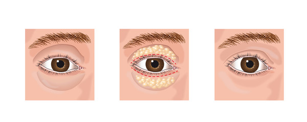 blepharoplasty