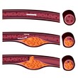 atherosclerosis plaque front and side view illustration