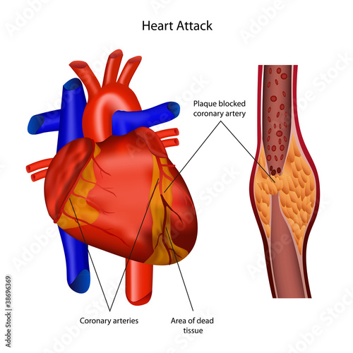 coronary artery heart attack illustration Stock Vector | Adobe Stock