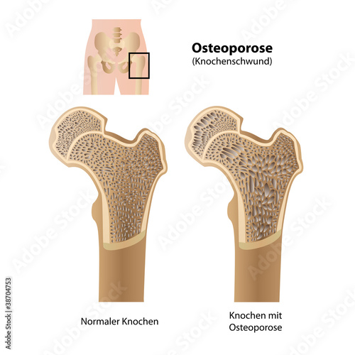 Fotografía Knochenschwund (Osteoporose) vektor illustration