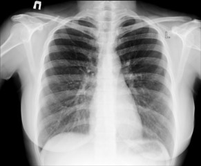 X-ray of chest