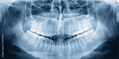 Fototapeta na wymiar X-ray scan of teeth