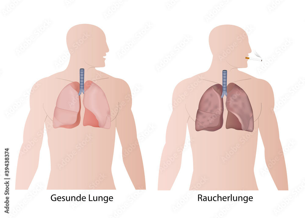 Raucherlunge Vs Normale Lunge Röntgenbild gamesageddon.com