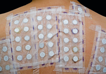 skin allergy test