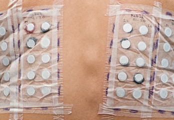 skin allergy test