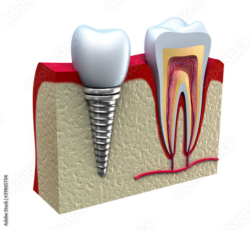 Fototapeta na wymiar Anatomy of healthy teeth and dental implant in jaw bone.