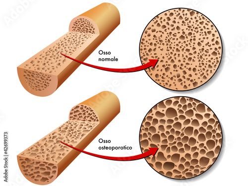 Naklejka na drzwi osteoporosi 2