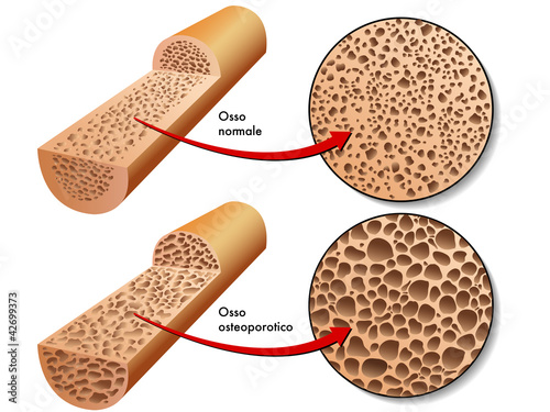 Naklejka dekoracyjna osteoporosi 2