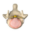 Intervertebral disc with pressure on spinal cord top view