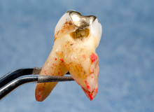 Rotten Tooth With Big Carious Hole And Gold Inlay