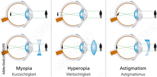 Cuadros en Lienzo The visual defects Myopia, Hyperopia and Astigmatism and how to correct it with biconcave and biconvex lenses