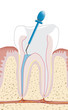 Zahnwurzelbehandlung, Endodontie 3