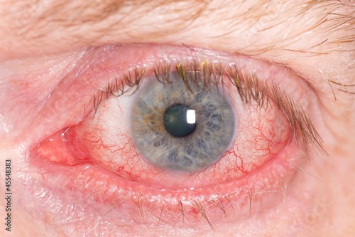Fotografía Close up of wide open red and irritated human eye