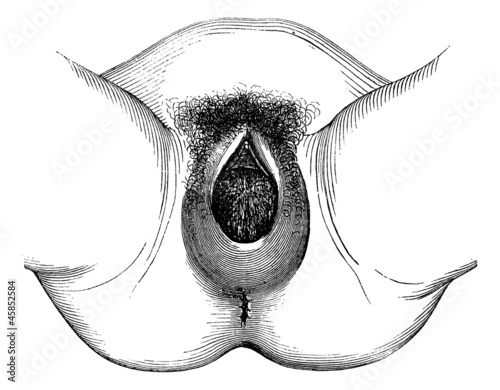 Fotografie, Obraz Perineal distention and dilation of the vulva, vintage engraving