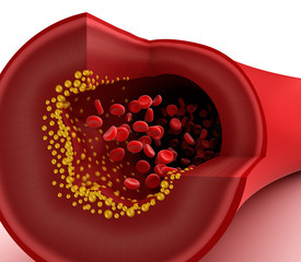 Wall Mural - Closeup view of cholesterol plaque in blood vessel