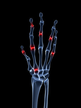 3d rendered illustration of an arthritic hand