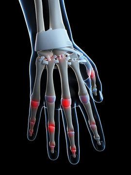 3d rendered illustration of painful finger joints