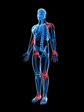 3d rendered illustration of painful joints