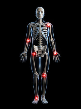 3d rendered illustration of painful joints