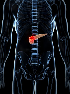 3d rendered illustration of the male pancreas - cancer