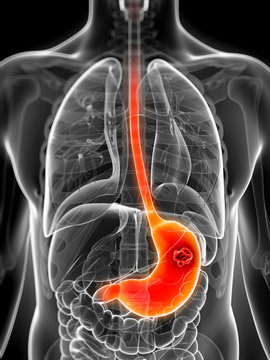 3d rendered illustration of the male stomach - cancer
